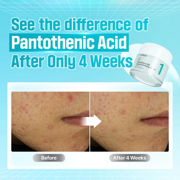 No.1 Pantothenic B5 Active Soothing Cream – Καταπραϋντική, ενυδατική κρέμα για ακμή, 80ml