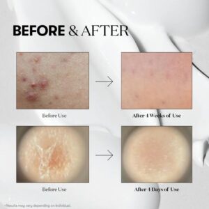 Reedle Shot 100 Essence – Ενισχυτικός ορός με φυσικές μικροβελόνες, 50ml