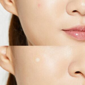 Acne Pimple Master Patch – Επιθέματα για επούλωση ακμής, 24τεμ